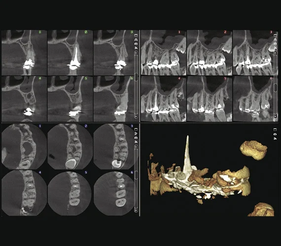Planmeca ProMax 3D Classic endodontic imaging